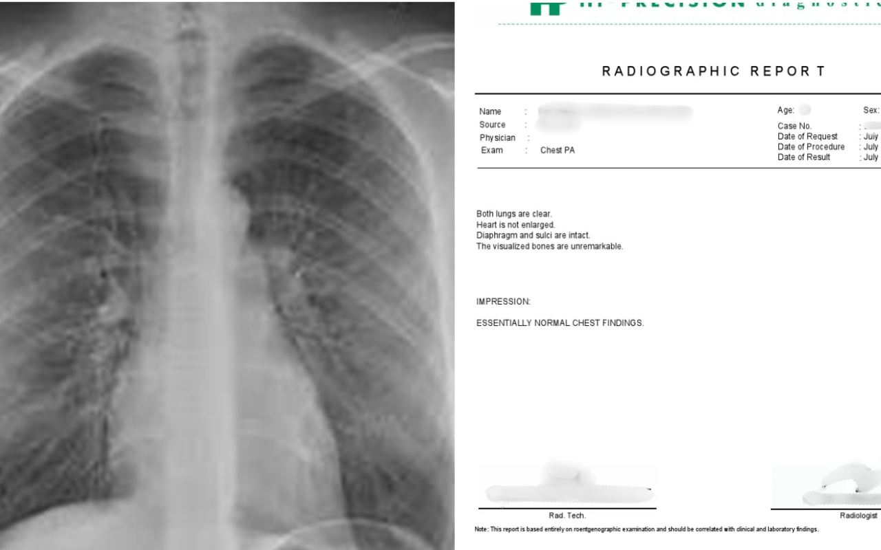 Chest X-ray